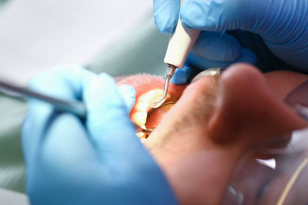 Best Emergency Wisdom Teeth Removal in Brownsburg, IN